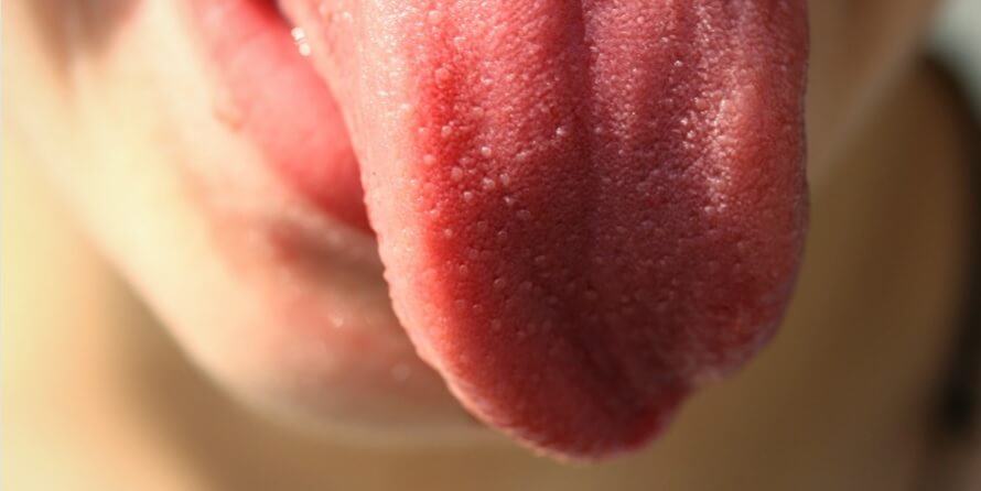 Top Five Home Remedies of Tongue Blisters